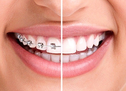 braces-1