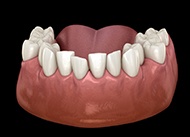 braces-3