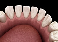 braces-4