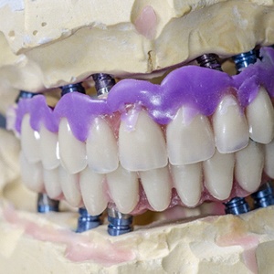 dentures-5