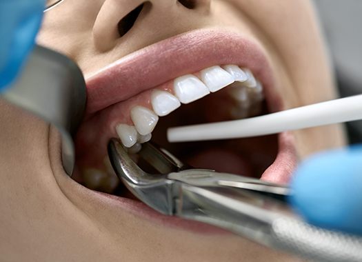 extractions-2