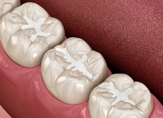 fillings-2