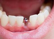implant-cost-2