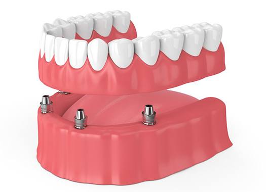 ret-dentures-2