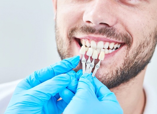 veneers-2