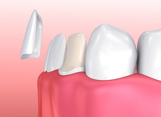 veneers-3